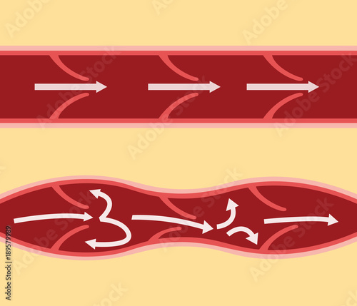 comparison compare between normal vein and varicose vein in horizontal alignment