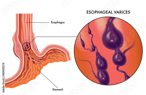 medical vector illustration of symptoms of esophageal varices