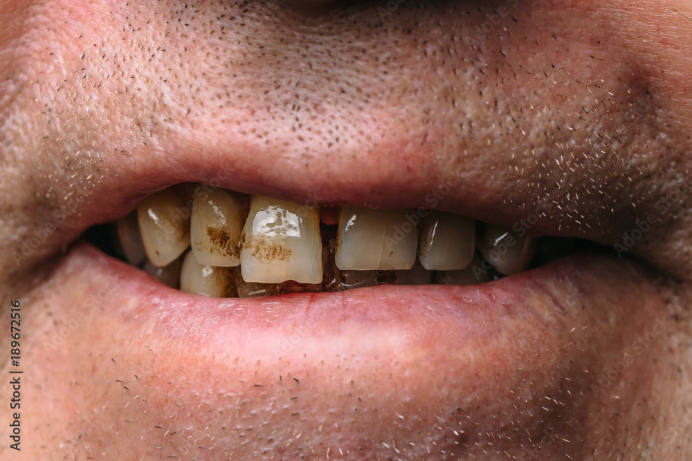 Naklejka premium Smiling mouth of smoker man with yellow teeth and tartar