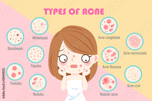 girl with types of acne