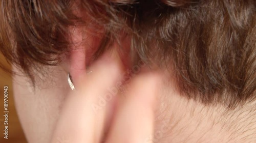 CLOSE UP Unrecognizable young woman suffering from psoriasis skin disease. Girl scratching itchy red scaly rash behind ears. Dermatological problems, eczema, dermatitis, symptoms, inflammatory illness