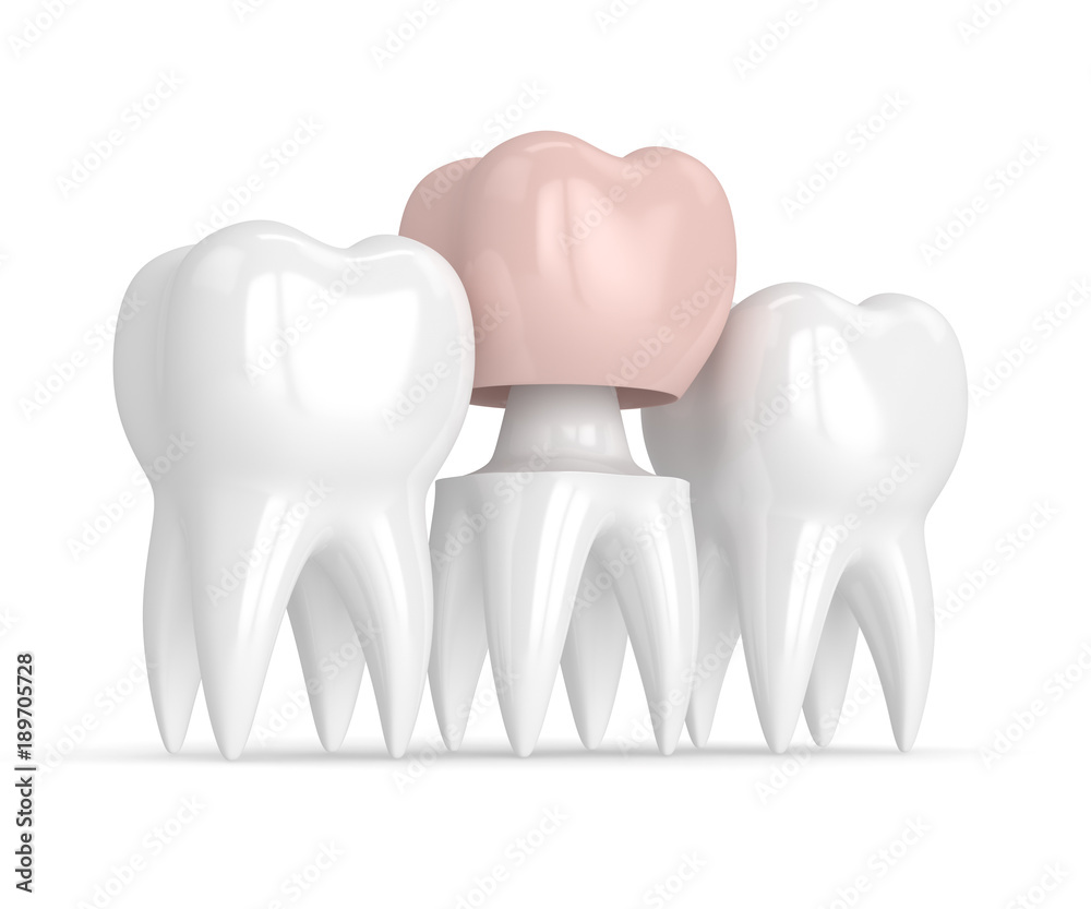 3d render of teeth with dental crown restoration 3d render of teeth with dental crown restoration