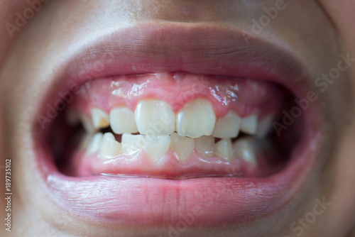 The teeth and gums are deformed and unattractive.