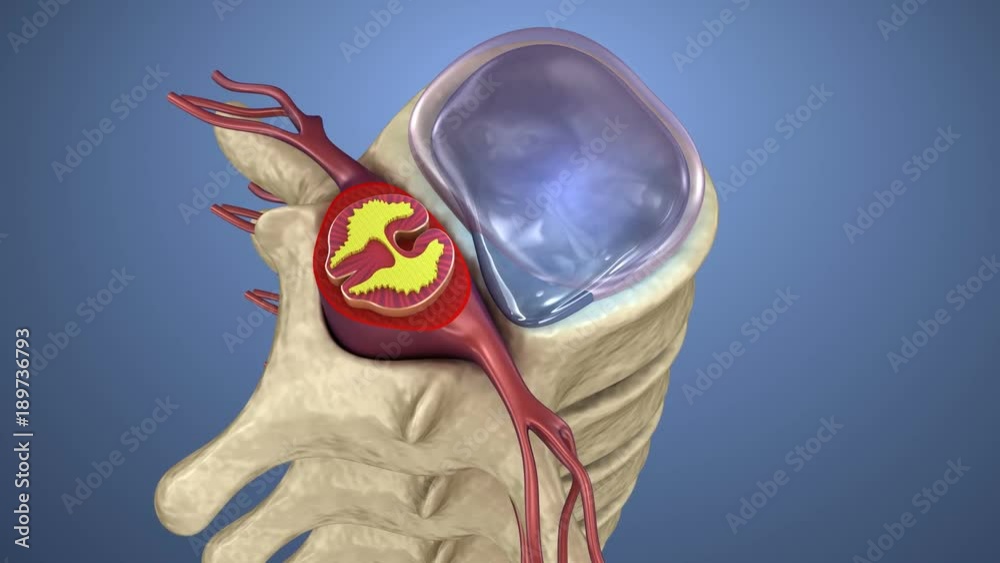 Spinal cord under pressure of bulging disc, 3d animation