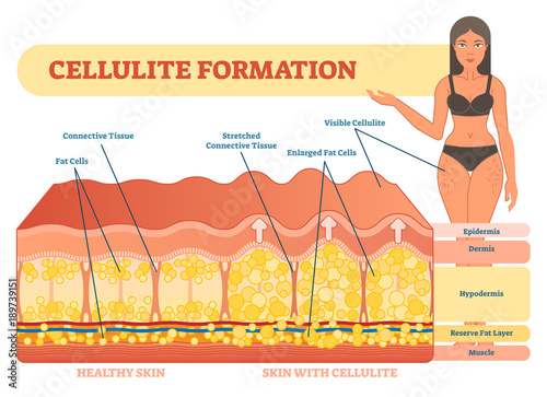 Cellulite formation vector illustration diagram, medical information scheme. 