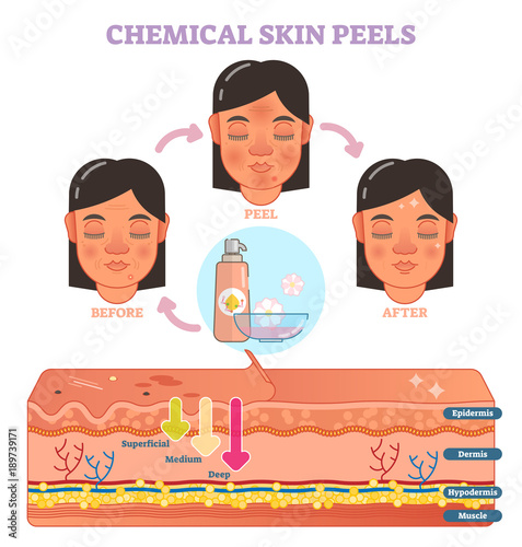 Chemical skin peels vector illustration diagram