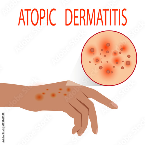 Atopic dermatitis health,  medical,  skin,  pain,  dermatitis,  eczema, photo