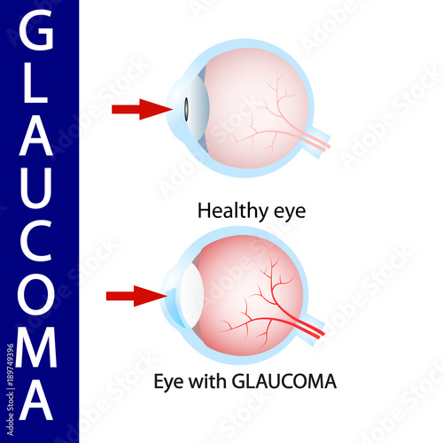 Glaucoma eye,  pressure,  optic,  nerve,  blindness,  