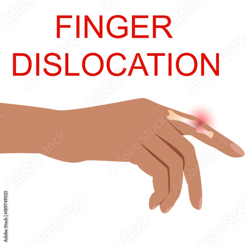 Finger Dislocation human medical  organ vector illustratio.