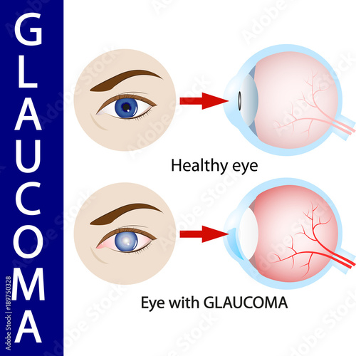 Glaucoma eye,  pressure,  optic,  nerve,  blindness,  