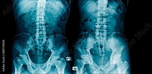 two spine xray image l-spondylosis and scoliosis photo