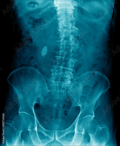 x-ray image show scoliosis thoracic spine