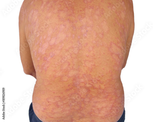 Tinea corporis , Fungal infection or Mycosis