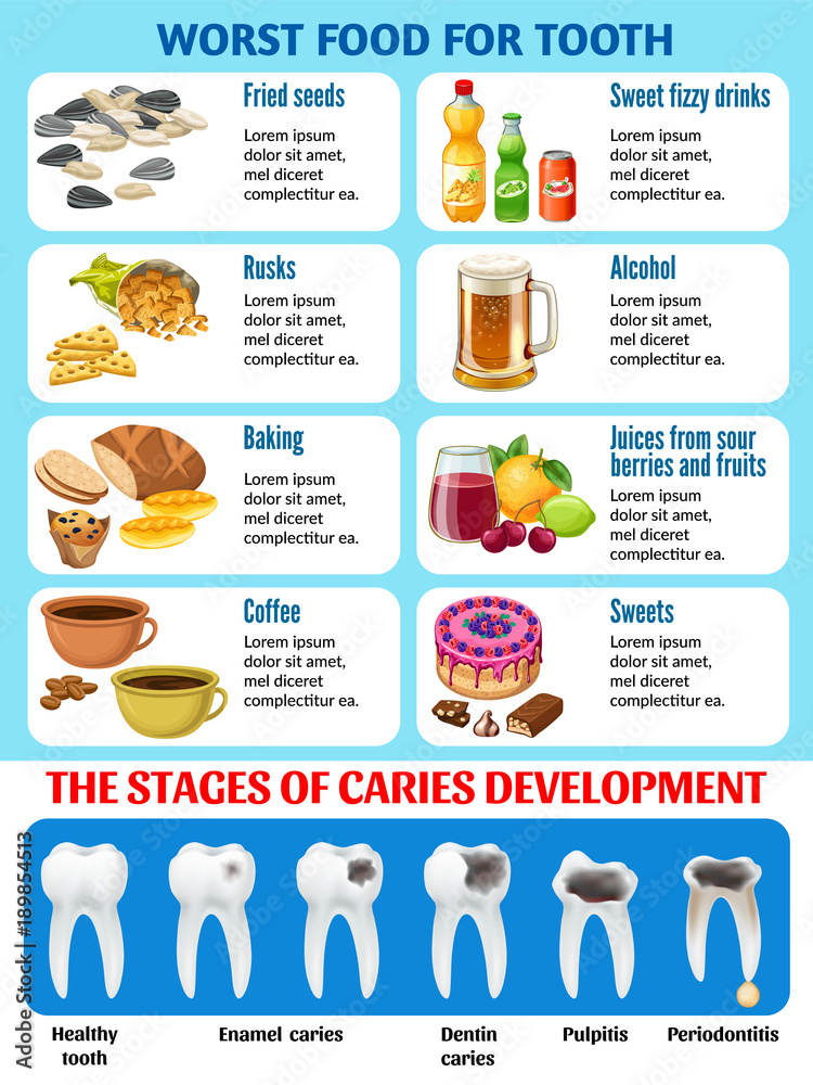 Infographic of harmful food for tooth and stages of caries development. Enamel and dentin decay, pulp decay and pulp infection banner for dentist office. Vector illustration. 