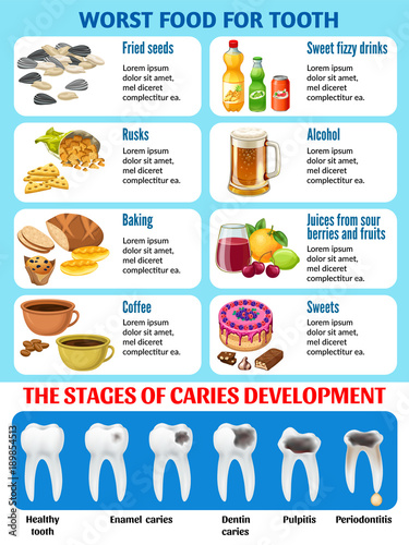 Infographic of harmful food for tooth and stages of caries development. Enamel and dentin decay, pulp decay and pulp infection banner for dentist office. Vector illustration. 