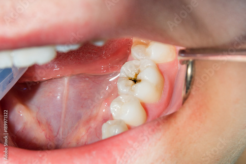 Fototapeta close-up of a human rotten carious tooth at the treatment stage in a dental clin