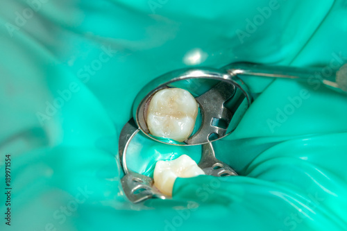 close-up of a human rotten carious tooth at the treatment stage in a dental clinic