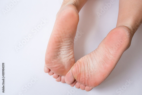 Dry female heels on a white background. Health & Foot Care