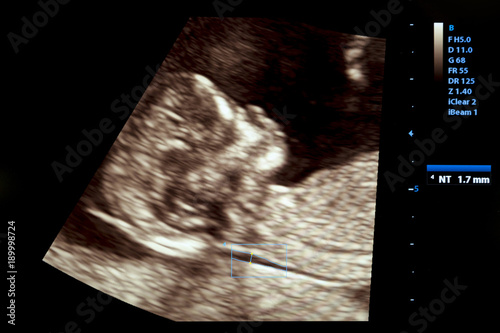 Obraz na płótnie Colourful image of pregnancy ultrasound monitor
