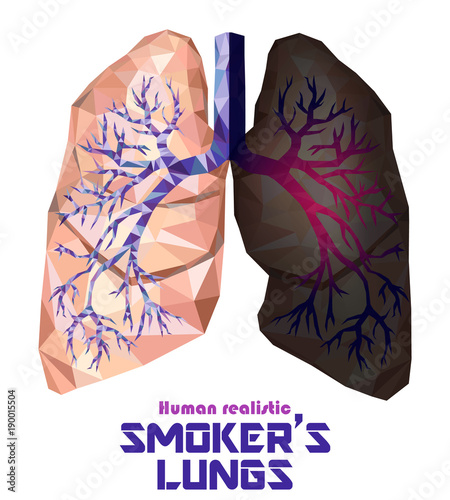 Low poly realistic human lungs and bronchus with cancer inflammation disease. Vector.