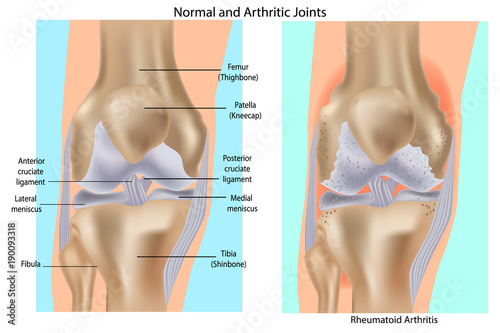 Normal and Arthritic Joints - Rheumatoid Arthritis of the knee