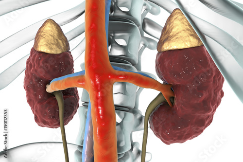Chronic kidney disease, 3D illustration showing diseased kidney with adrenal glands, urethers, blood vessels and skeleton
