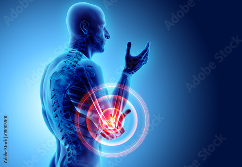 Canvas Print 3d illustration of human elbow injury.