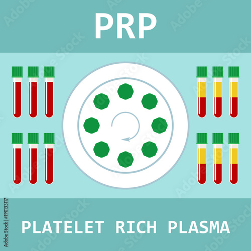 Platelet rich plasma. PRP method. Vector.