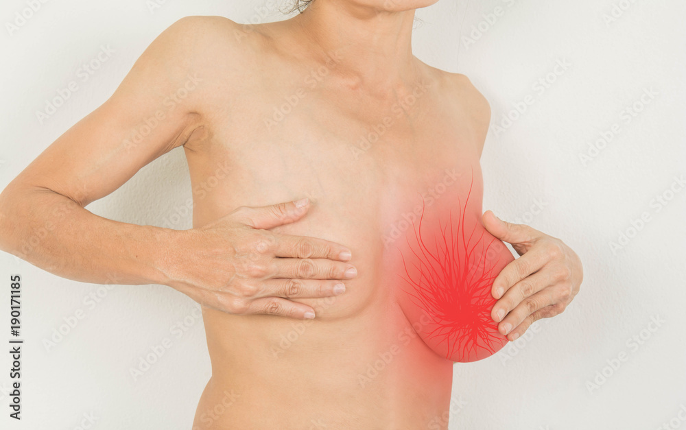 Breast with tumor inside And have an abnormal chest. Breast with tumor inside And have an abnormal chest.