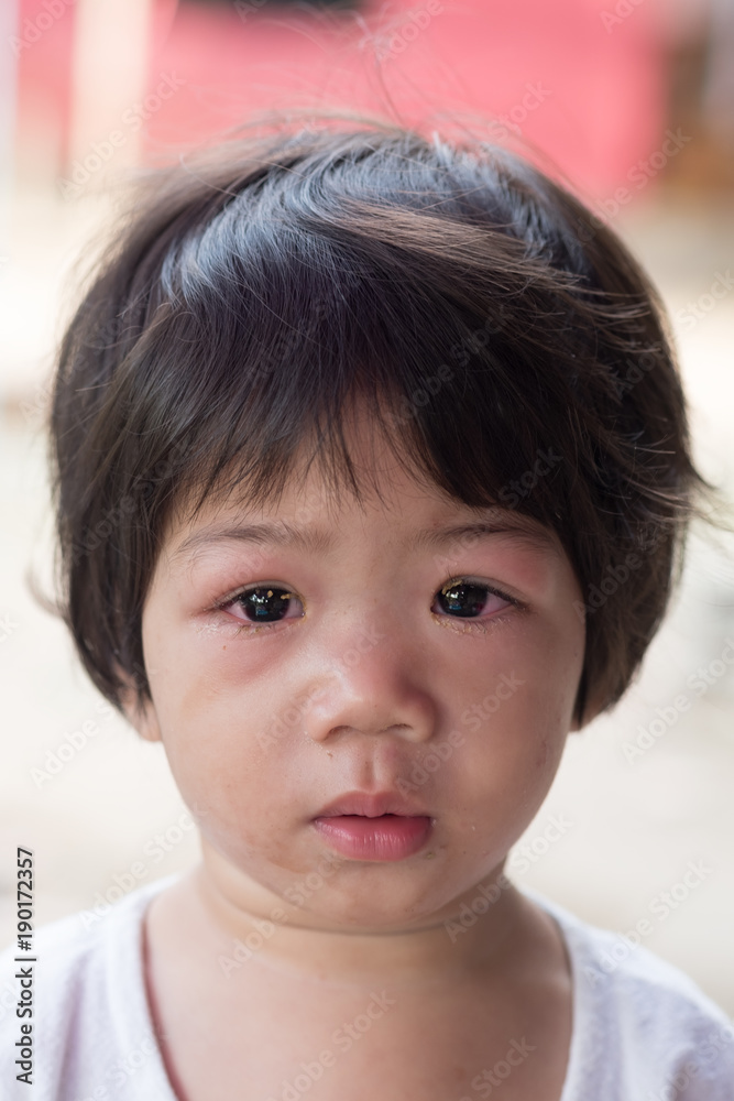 Eye with infection. Eye with infection.