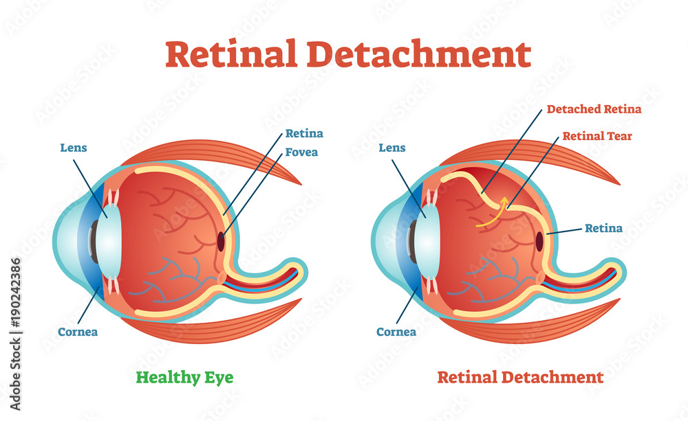 Retinal Detachment vector illustration diagram, anatomical scheme. 