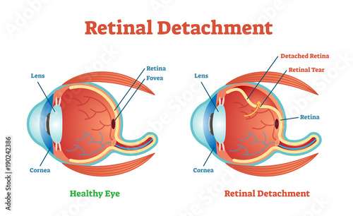 Retinal Detachment vector illustration diagram, anatomical scheme.  photo