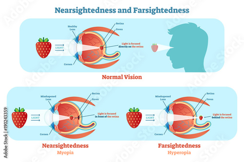Far Sightedness and Near Sightedness vector illustration diagram, anatomical scheme. 