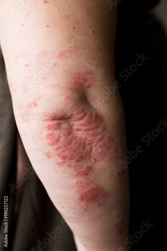 The problem with many people - eczema on hand. Dark background. Man itchind skin.