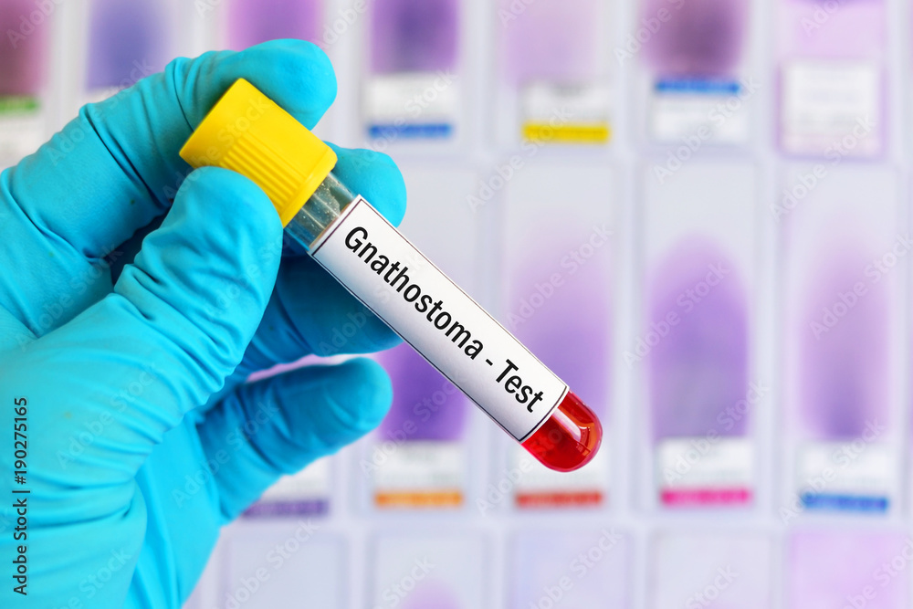 Test tube with blood sample for Gnathostoma parasite test Test tube with blood sample for Gnathostoma parasite test