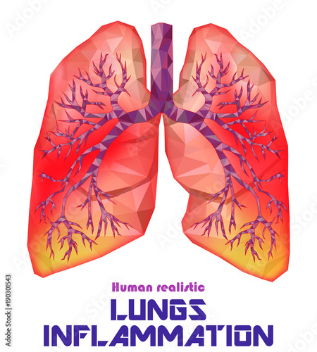 Sick human realistic lungs and trachea in low poly. Pleurisy, an inflammation around the lungs.   Vector.