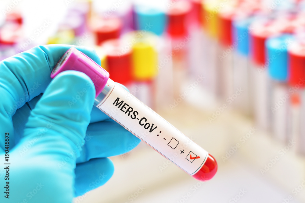 Fototapeta premium Blood sample positive with MERS-CoV (Middle East respiratory syndrome coronavirus)