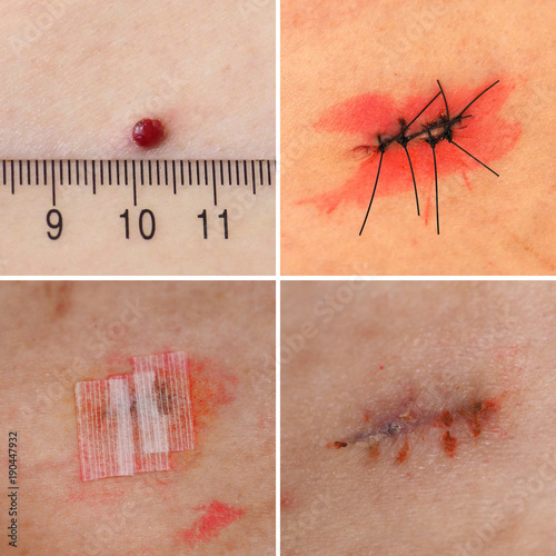 Surgical removal of Pyogenic granuloma on skin photo