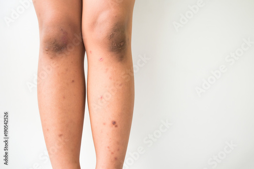 Dark Spots On Legs Dark Spots On Legs