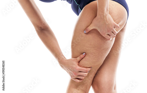 Obraz na płótnie Cellulite on female legs.