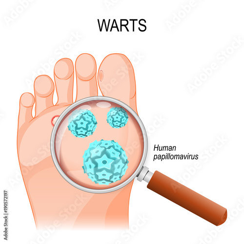 Foot warts. Close-up of HPV