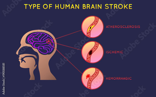Brain Stroke icon design, infographic health, medical infographic. Vector illustration