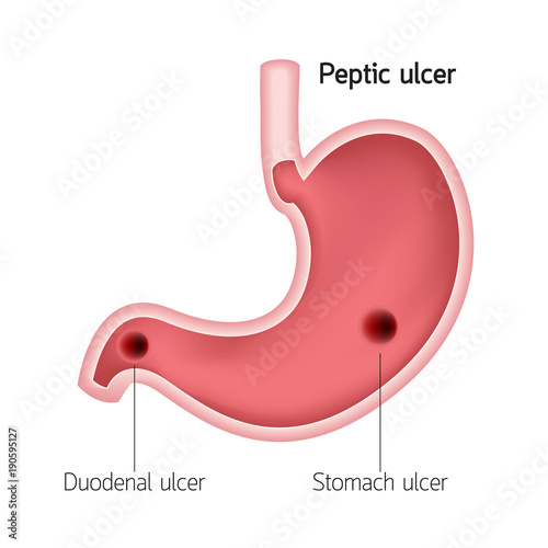 Cross section of human stomach. Peptic ulcer, human heath care. Vector illustration isolated on white background