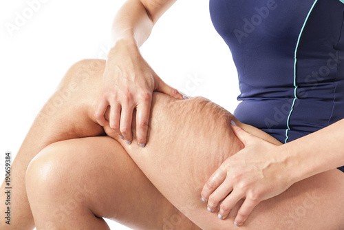 Εκτύπωση καμβά Cellulite and loose skin.