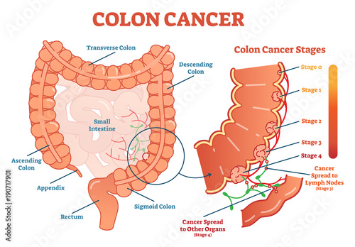 Colon cancer medical vector illustration scheme, anatomical diagram with cancer stages photo
