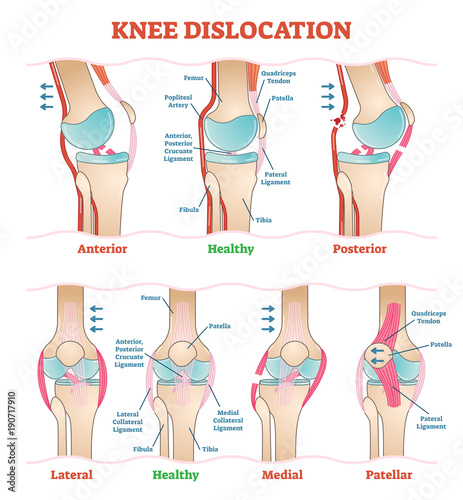Knee Dislocations - medical vector illustration diagrams. Anatomical knee injury types scheme.  photo