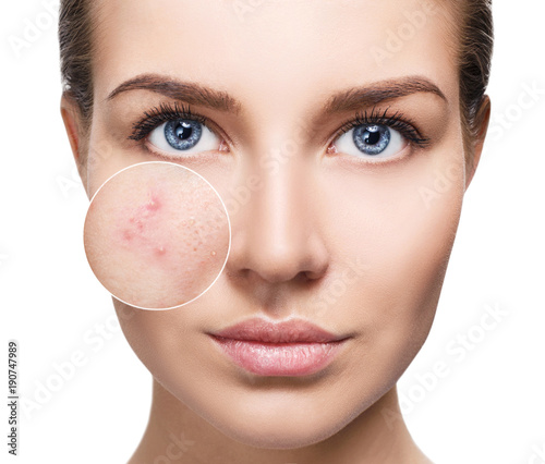 Young woman with acne skin in zoom circle.