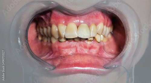 Mouth with prosthetic teeth