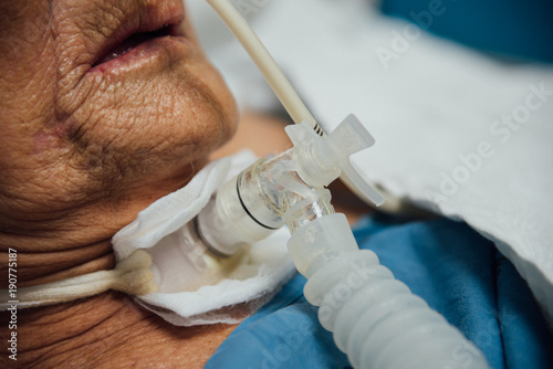 Patient do tracheostomy and ventilator in hospital photo