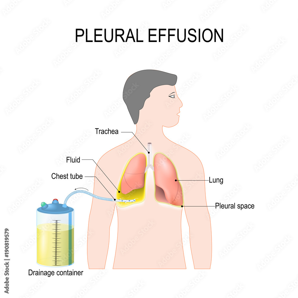 Pleural effusion. Treatment of tension hydrothorax Stock Vector Adobe